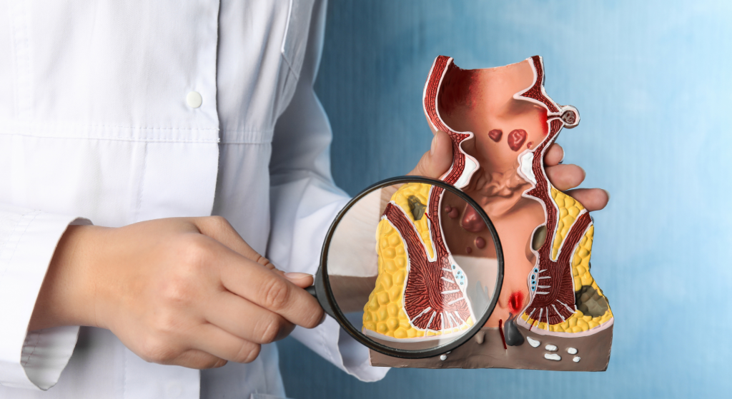 Hemorroides_ causas, síntomas y tratamientos efectivos_ Hemorroides_ causas, síntomas y tratamientos efectivos