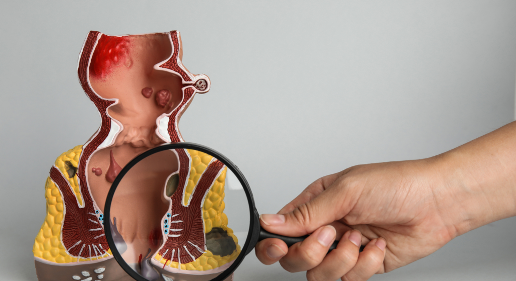 Técnicas mínimamente invasivas en coloproctología