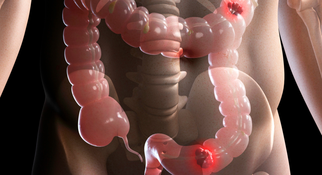 Radioterapia en cáncer colorrectal_ efectos secundarios y beneficios