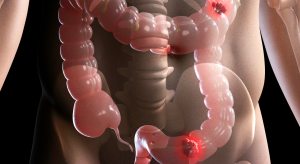 Radioterapia en cáncer colorrectal_ efectos secundarios y beneficios
