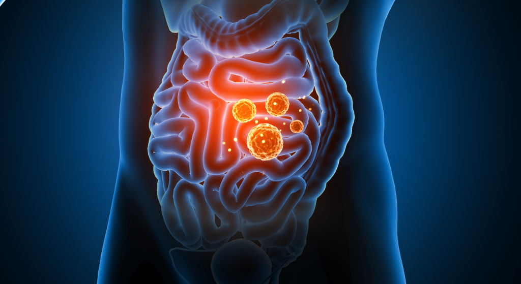 Impactación fecal_ qué es y cómo tratarla